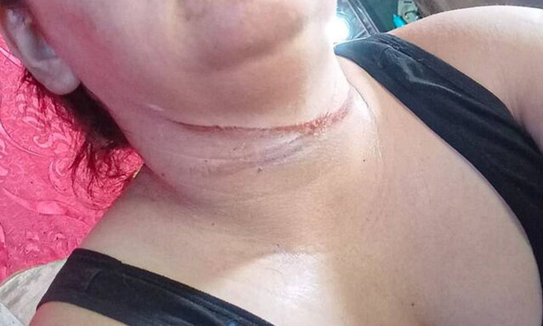 Mujer sufre graves cortes en el cuello por cable suelto en pleno centro de Asunción - OviedoPress