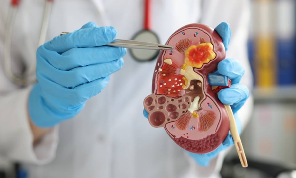 Coronel Oviedo se suma al Día Mundial del Riñón con jornada de concienciación y detección temprana - OviedoPress