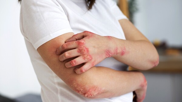 Psoriasis: Afección de la piel que puede dañar a las articulaciones