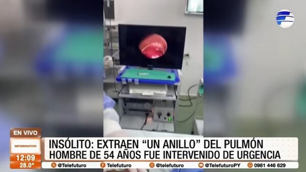 Insólito - Extraen un anillo del pulmón de un paciente