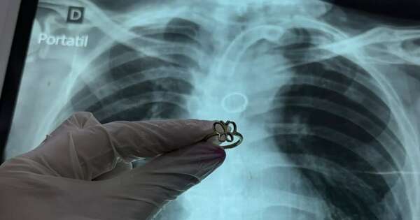 La Nación / Hallan un anillo de oro en el pulmón de un paciente traqueostomizado