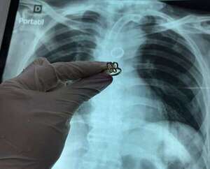 Ineram: el insólito hallazgo dentro del pulmón de un hombre de 54 años - Nacionales - ABC Color