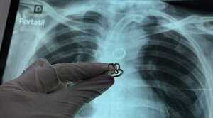 Hallan anillo en el pulmón de paciente con traqueotomía y desconocen cómo llegó allí - Noticiero Paraguay