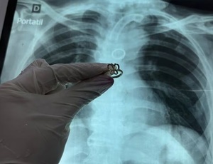 Ineram: extraen anillo de oro del pulmón de paciente