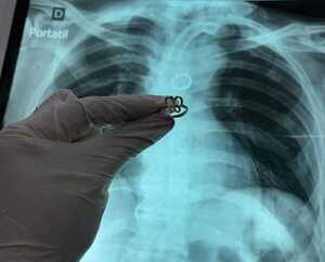 Popular / Extraen anillo de oro del pulmón de un karai traqueostomizado