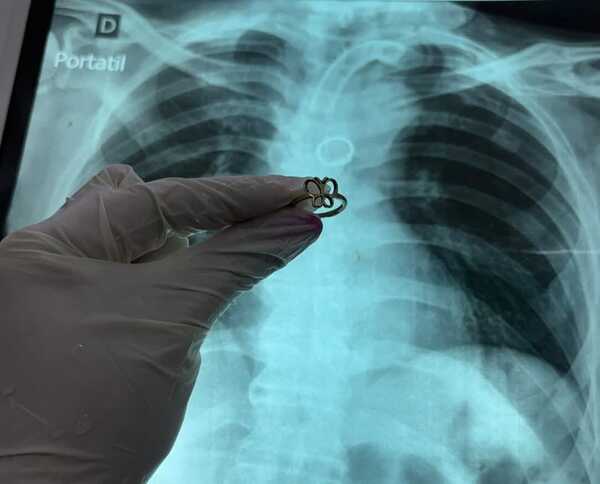 Popular / Extraen anillo de oro del pulmón de un karai traqueostomizado