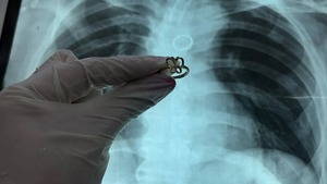 Hallan anillo de oro en forma de mariposa en el pulmón de un paciente en el Ineram