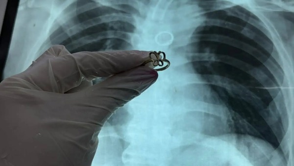 Hallan anillo de oro en forma de mariposa en el pulmón de un paciente en el Ineram