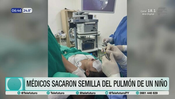 Exitosa extracción de semilla del pulmón de un niño