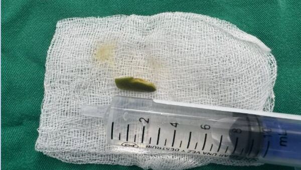 Pequeñito aspiró semilla de ingá y fue intervenido