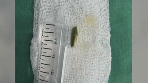 Bebé traga semilla de ingá y es sometido a intervención médica para extracción
