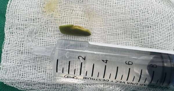 La Nación / Extrajeron semilla de ingá del pulmón de un niño en el Ineram