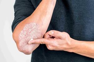 Psoriasis: la enfermedad silenciosa que va más allá de la piel y amenaza el corazón