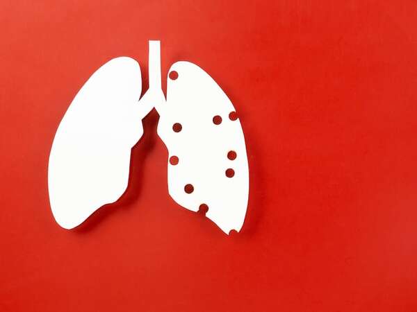 Día Mundial de la Tuberculosis: el día que la ciencia identificó su origen - Ciencia - ABC Color