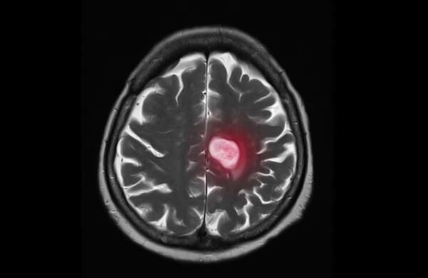 Descubren fármaco para frenar la metástasis cerebral del cáncer - Ciencia - ABC Color