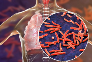 Casos de tuberculosis muestran tendencia al aumento en el país