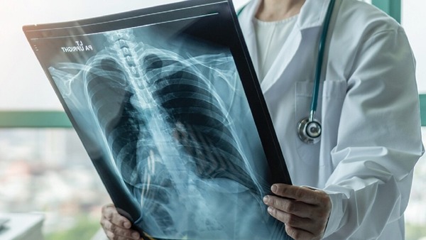 Casos de tuberculosis crecen en Paraguay y alertan sobre diagnóstico tardío - ADN Digital