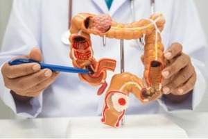 Cáncer de colon: la detección temprana eleva las probabilidades de cura al 90%