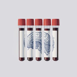 ¿Podría un análisis de sangre predecir si padecerás Alzheimer?