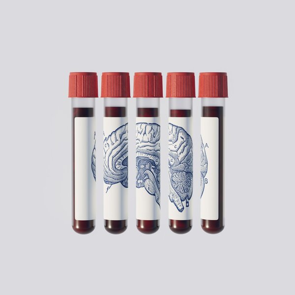 ¿Podría un análisis de sangre predecir si padecerás Alzheimer?