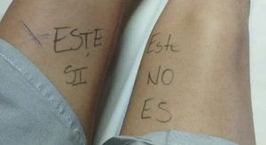 Paciente escribió en su pierna para evitar error médico
