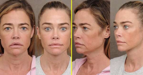 Diario HOY | Denise Richards “rejuveneció” con lifting facial