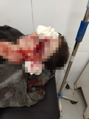 Mujer quedó con el rostro desfigurado tras salvaje ataque de su perro | Unicanal