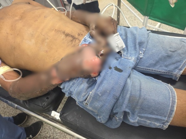 Habría incendiado la casa de su padre y resultó con graves quemaduras - Concepción al Día