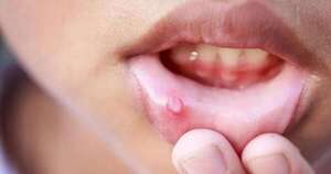 La Nación / Herpes labial en niños: síntomas y cuidados clave