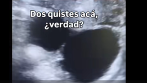 Consultó por quistes y pillaron que está embarazada a sus 48 años