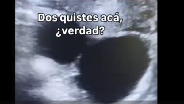 Consultó por quistes y pillaron que está embarazada a sus 48 años