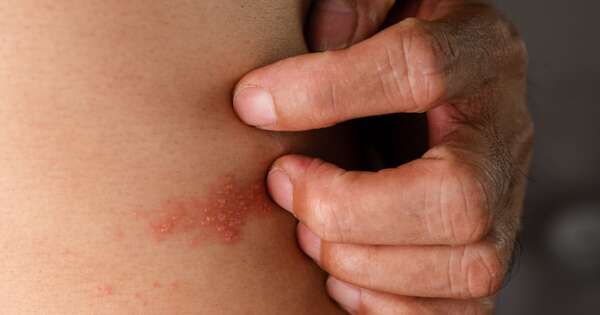 La Nación / Dolor que alerta: claves para detectar el herpes zóster a tiempo