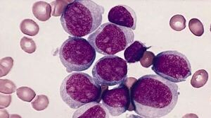 Nuevos tratamientos cambian el pronóstico de la leucemia mieloide aguda