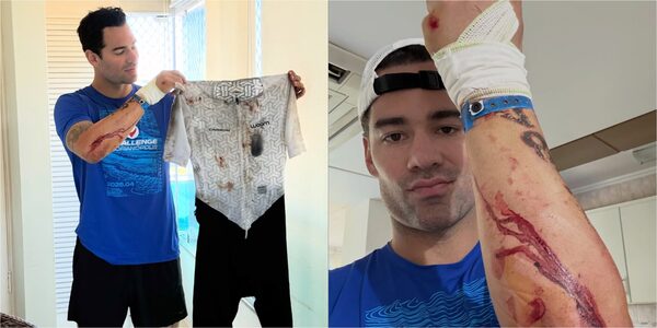 Popular / (GALERÍA) Renato Prono y un feo accidente: "Feliz de poder estar contando la historia"