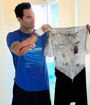 Renato Prono tras un accidente, el susto que lo dejó con vida para contarlo - Canal-E