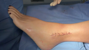 Mujer se fracturó ambas piernas por baches sobre Félix Bogado