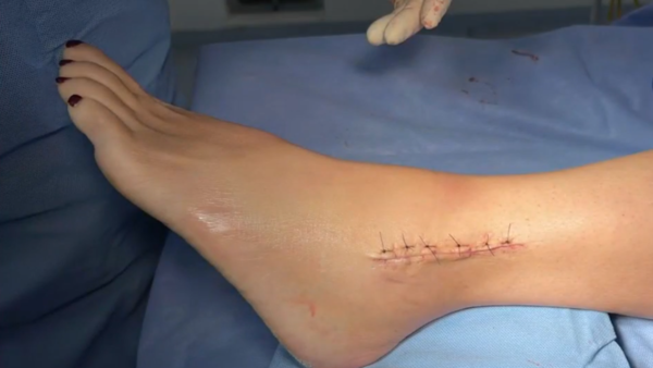 Mujer se fracturó ambas piernas por baches sobre Félix Bogado