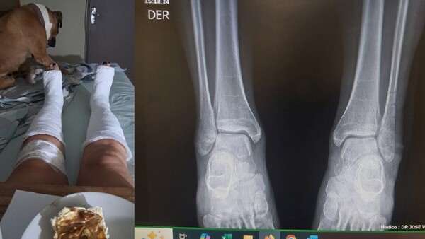 Doña se fracturó las dos piernas al caer en un bache