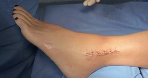 Mujer sufrió doble fractura tras caer en un bache