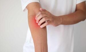 Dermatitis atópica impacta en la salud mental y el rendimiento laboral, advierten especialistas