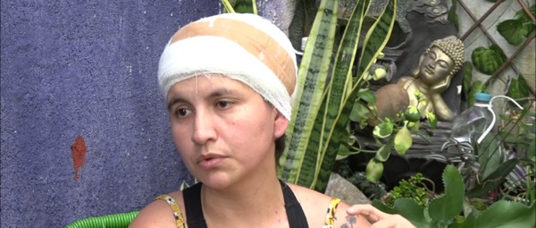 Mujer que quedó sin cuero cabelludo tras accidente necesita ayuda - trece