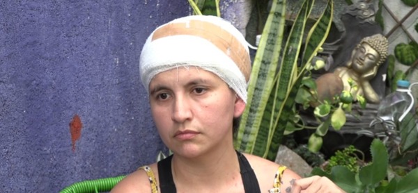 Mujer que perdió el cuero cabelludo en accidente pide ayuda para continuar su tratamiento