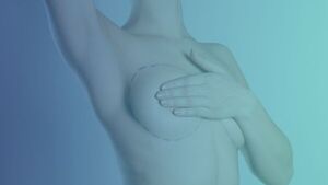 Impulsan ley para garantizar reconstrucción mamaria a pacientes con cáncer