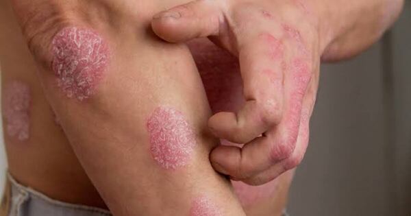 Diario HOY | Proyecto para tratar la psoriasis pasa al Senado tras aprobación en Diputados