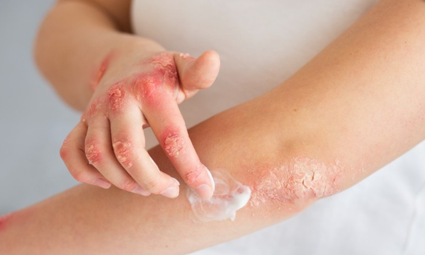 La Cámara de Diputados da media sanción a programa nacional para tratar la psoriasis - OviedoPress